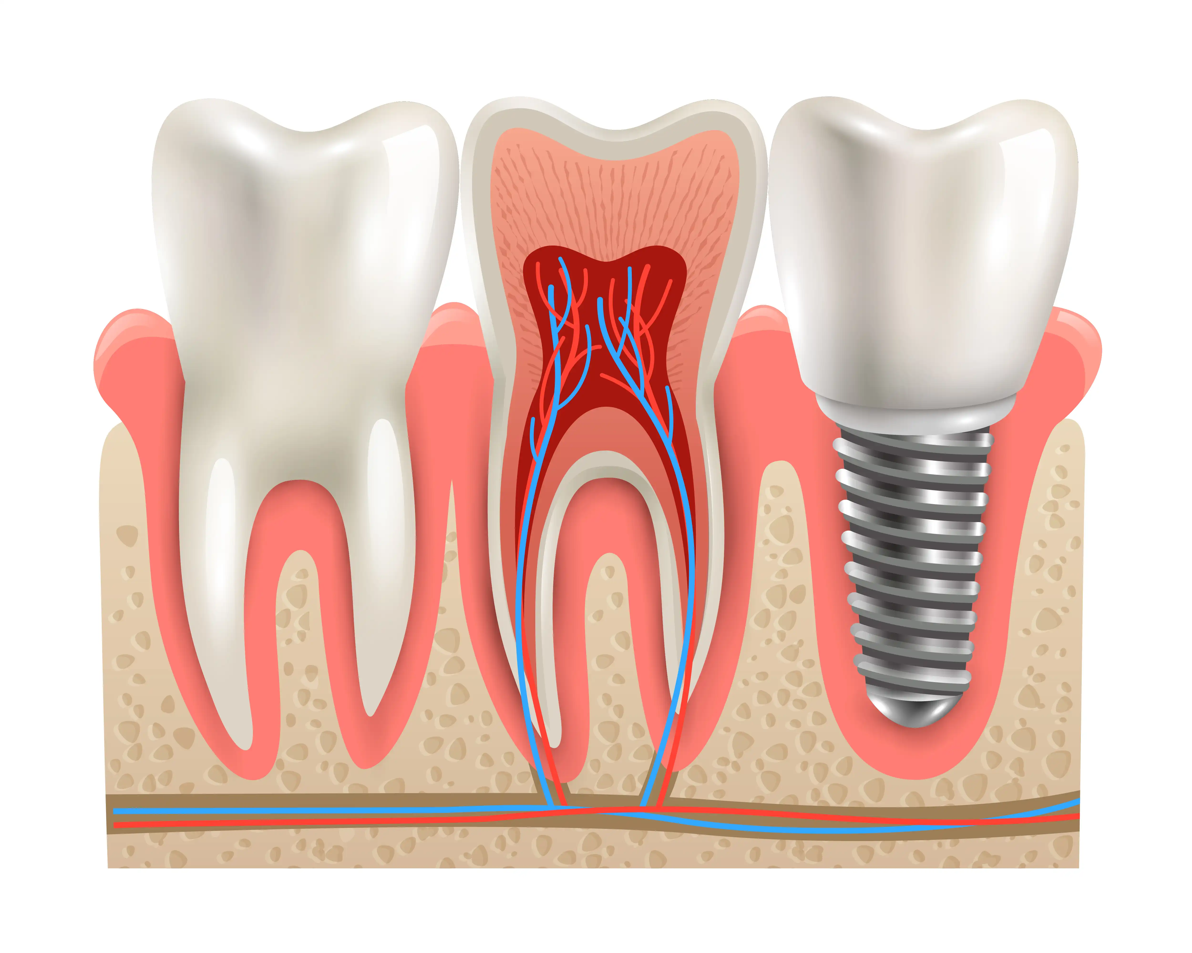 Tratamiento de endodoncia